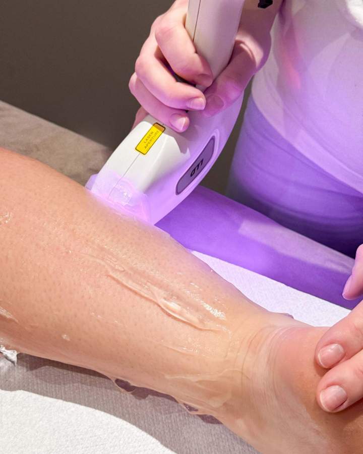 Épilation laser LEMPDES